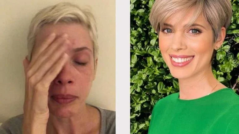 Dani Valente explica fibromialgia com foto de antes e depois da doença
