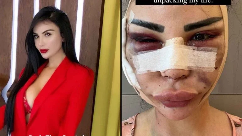 Modelo brasileira denuncia violência cirúrgica na Turquia; imagens fortes