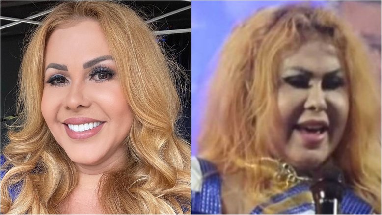Sinusite bacteriana: conheça doença que causou inchaço e afastou Joelma dos palcos