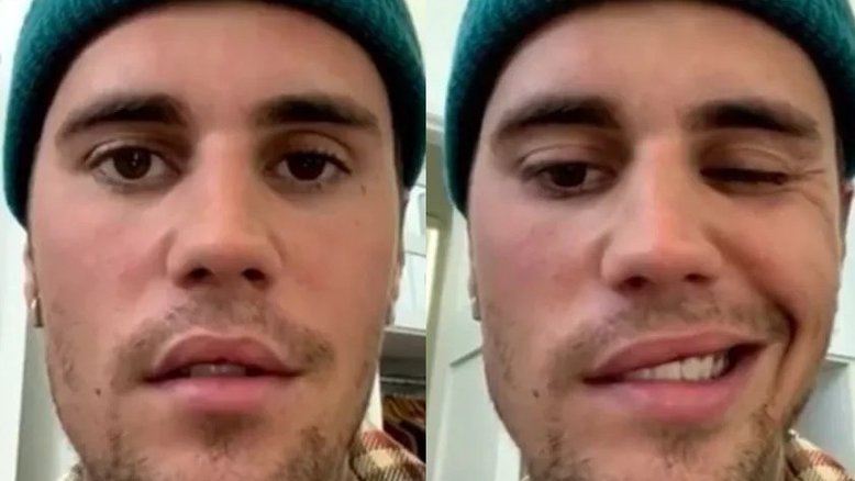 Ramsay Hunt: conheça a síndrome que causou paralisia facial em Justin Bieber