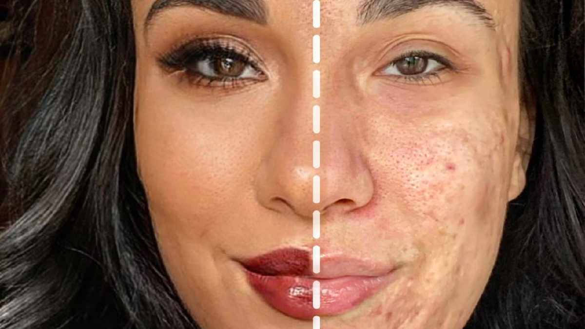 Influenciadora choca web ao mostrar rosto metade maquiado e metade com acne