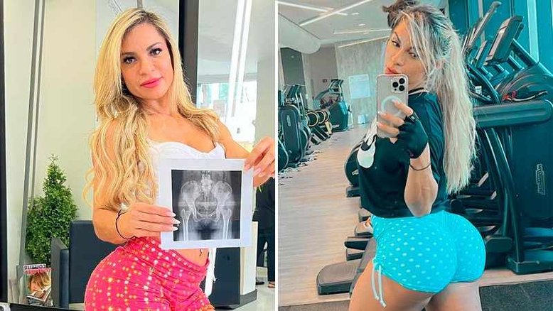 Candidata ao Mis Bumbum prova com raio-x que bumbum é natural