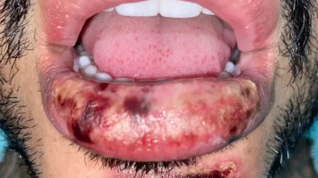 MG: Harmonização facial mal sucedida deixa feridas e boca de modelo deformada