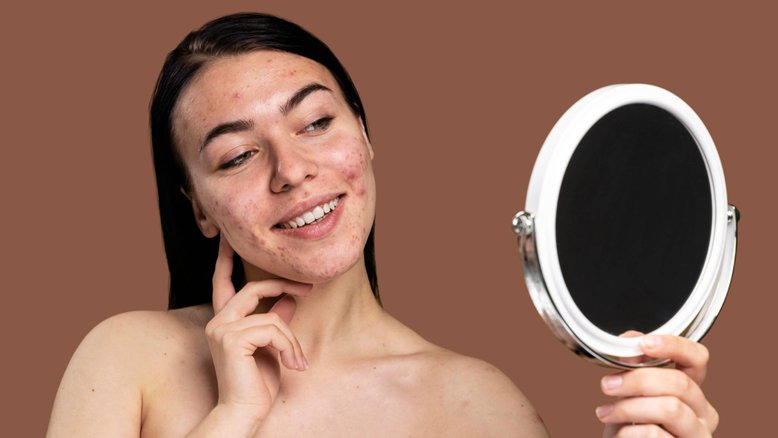 mulher com pele acneica, como tratar acne