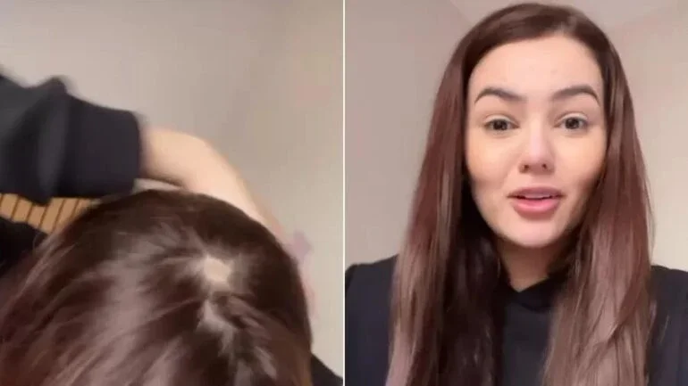 ‘É bizarro’: Entenda a doença que atingiu a ex-BBB Eslovênia