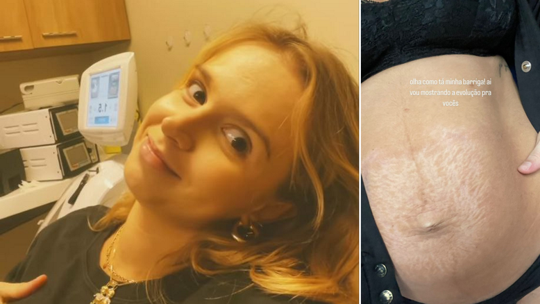 Isabella Scherer faz tratamento para estrias e flacidez após parto de gêmeos
