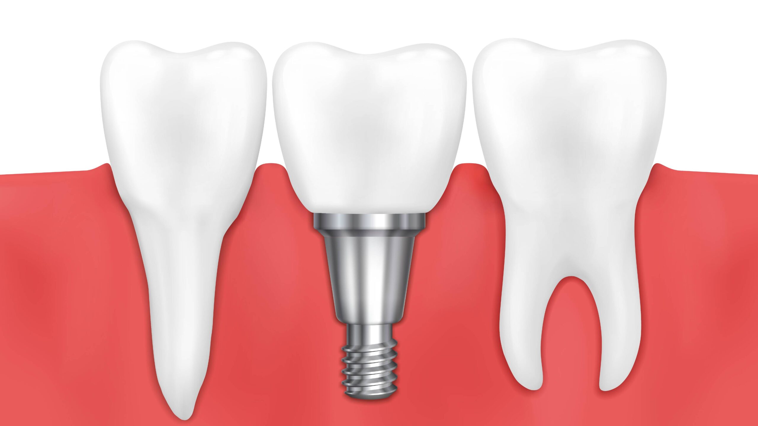 Implantes dentários: técnica garante melhora do sorriso e pode ser feita com rapidez