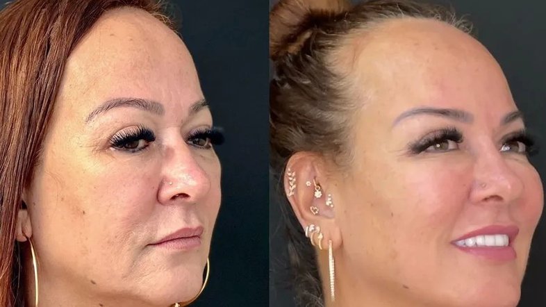 Mãe de Neymar, Nadine Gonçalves realiza rejuvenescimento facial e  procedimento no bumbum - ISTOÉ Independente