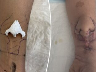 Lipo de papada: Cirurgião explica procedimento estético feito por Jojo  Todynho - ISTOÉ Independente