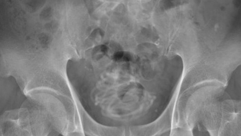 Divulgação/Urology Case Reports