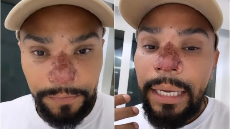Médico explica problema no nariz de Naldo Benny e alerta para 'danos irreversíveis'