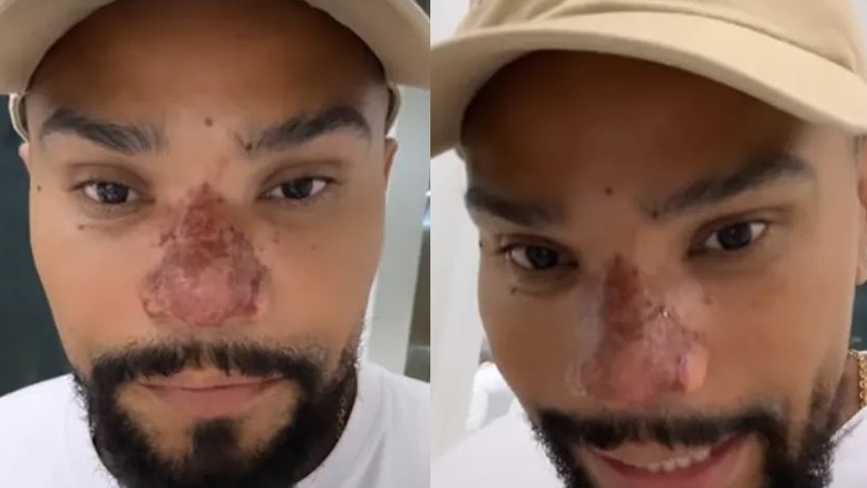 Naldo passa por tratamento após complicações de procedimento no nariz
