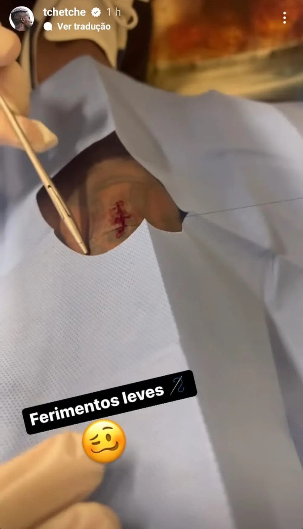 Tchê Tchê leva pontos na canela após vitória contra o Atlético-MG: 'Ferimentos leves' 4 Tchê Tchê leva pontos na canela após vitória contra o Atlético-MG: 'Ferimentos leves'