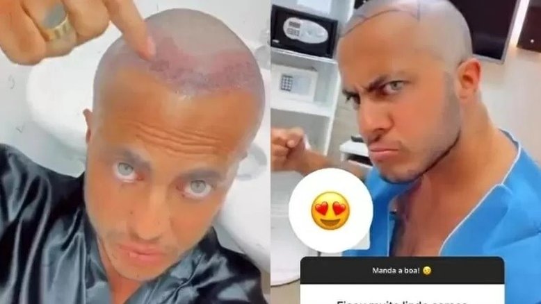 'Achei que ia ficar feio careca', diz Thammy Miranda sobre transplante capilar