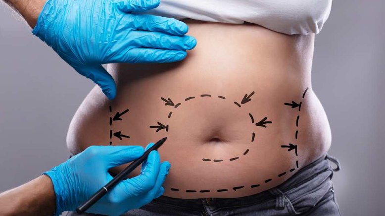 Lipo a laser é mais segura? Pioneiro na técnica, Wendell Uguetto explica