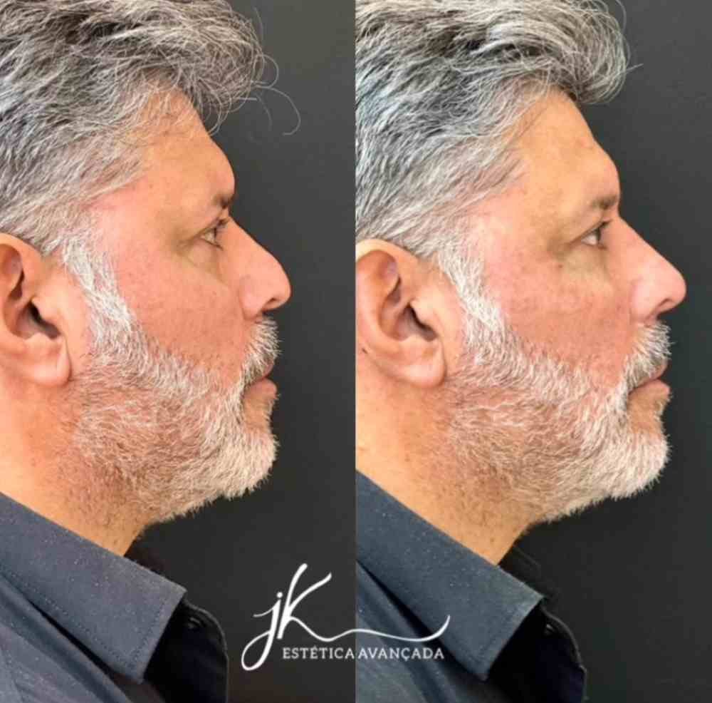 Antes e depois: Nariz de Alexandre Frota fica arrebitado após harmonização facial