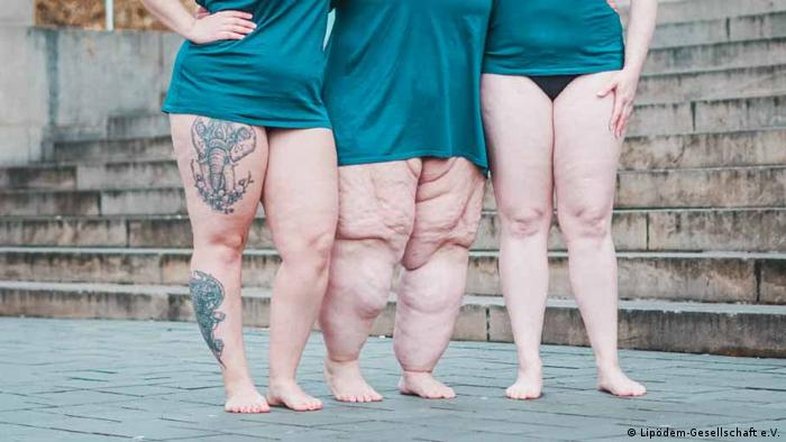 Lipedema nada tem a ver com obesidade ou má nutrição