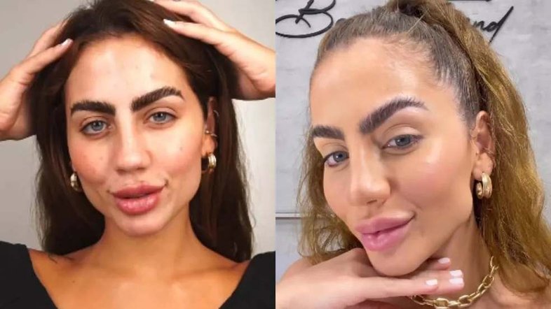 'Fórmula de bolo': Harmonização facial de Catherine Bascoy é detonada e médica alerta