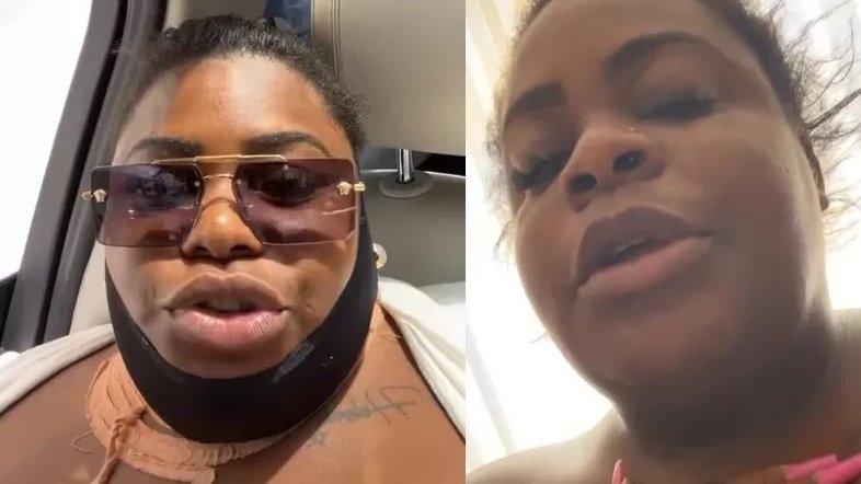 'Já melhorou muito', diz Jojo Todynho ao mostrar resultado de lipo da papada