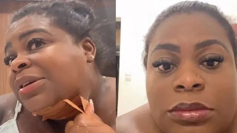 Jojo Todynho tira curativos e mostra resultado da sua lipo de papada: 'Amei'