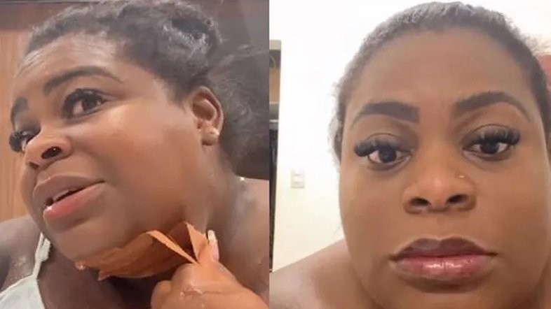 Jojo Todynho tira curativos e mostra resultado da sua lipo de papada: 'Amei'
