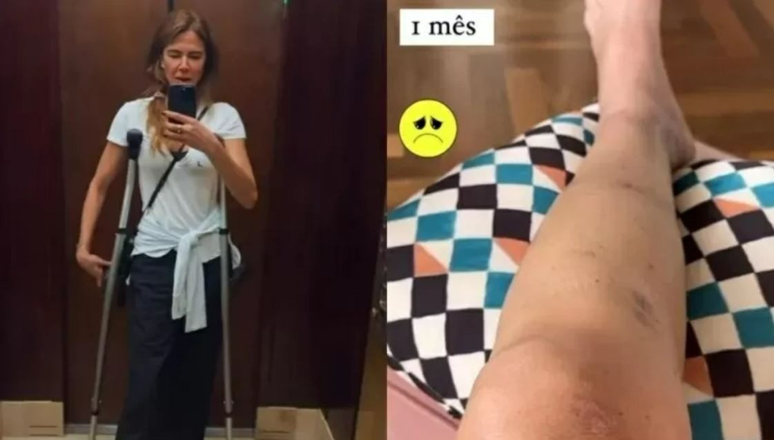 Vídeo: Luciana Gimenez mostra cicatrizes na perna após acidente de ski