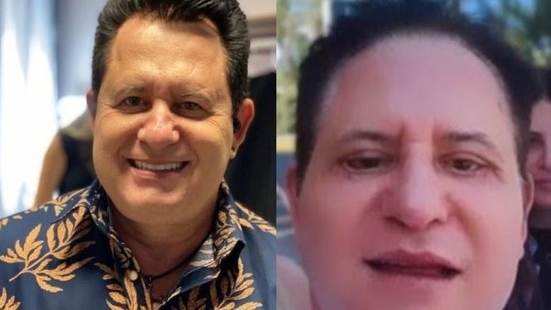 Blefaroplastia de Marrone: Cirurgião plástico explica procedimento polêmico do cantor