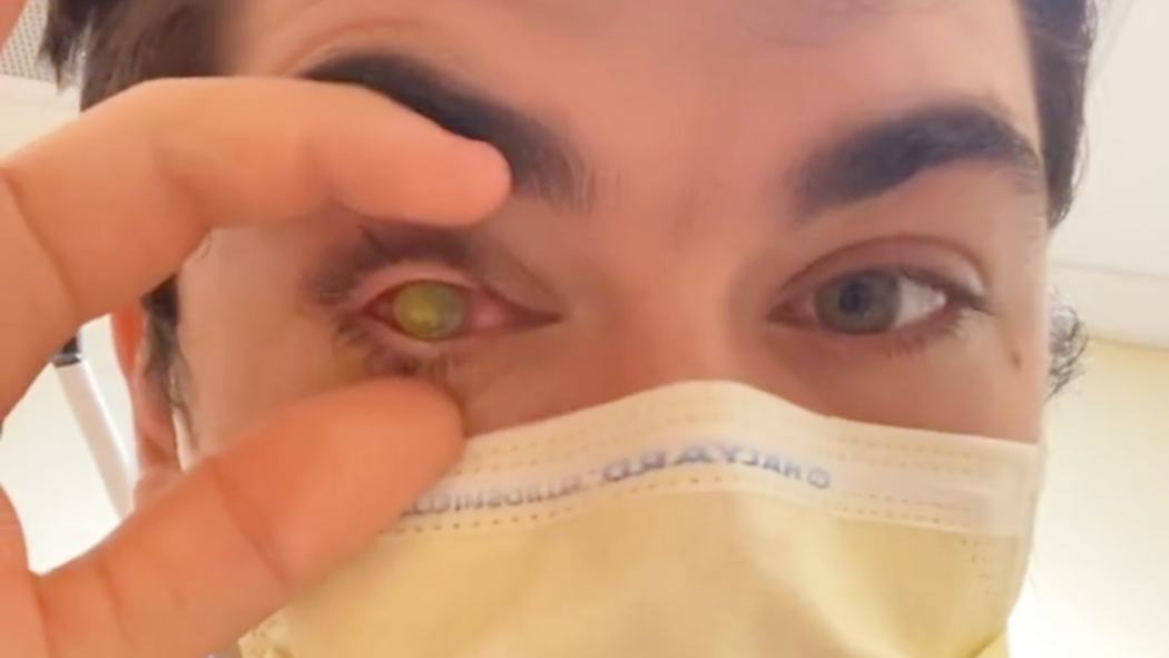 'Tenho gritado de dor': Jovem perde a visão por parasita e especialistas explicam riscos da lente de contato