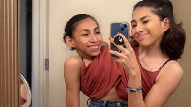 Gêmeas siamesas, de 22 anos, contam como é compartilhar a rotina: uma namora e outra é assexual