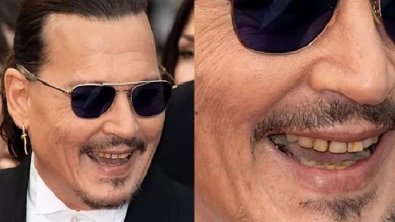 Dentista faz alerta após Johnny Depp aparecer com dentes podres e Cannes