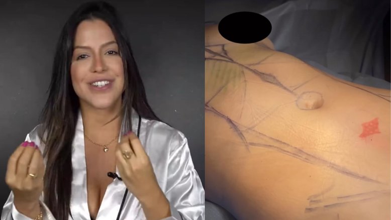 Laís Caldas adere à lipo LAD e mostra antes e depois