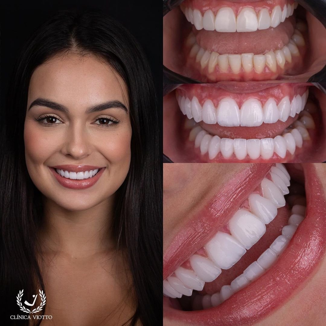 Ex-BBB Larissa troca lentes de contato e mostra novo sorriso: 'Me incomodava' 13 Ex-BBB Larissa troca lentes de contato e mostra novo sorriso: 'Me incomodava'