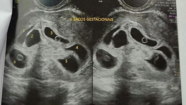 Ultrassom de sêxtuplos