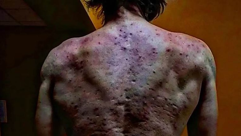 Americano desenvolve quadro grave de acne nas costas por tomar anabolizante: ‘Dor mais intensa que já experimentei’