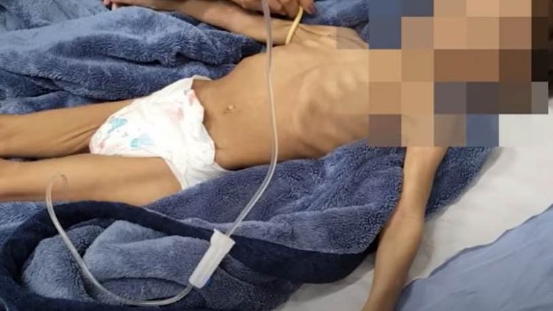 SP: Menina de três anos é resgatada desnutrida por ficar 40 dias sem comida; pai responde caso em liberdade