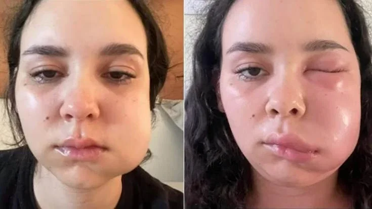 Jovem tem infecção após retirada dos sisos e viraliza nas redes ao mostrar evolução do caso