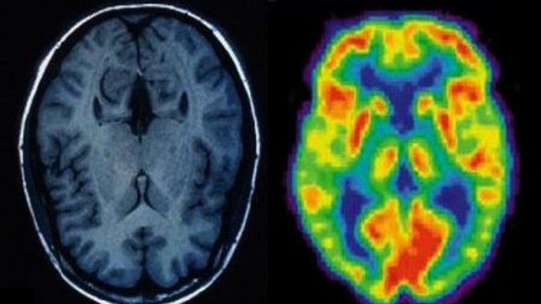 Italianos identificam nova mutação causadora do Alzheimer