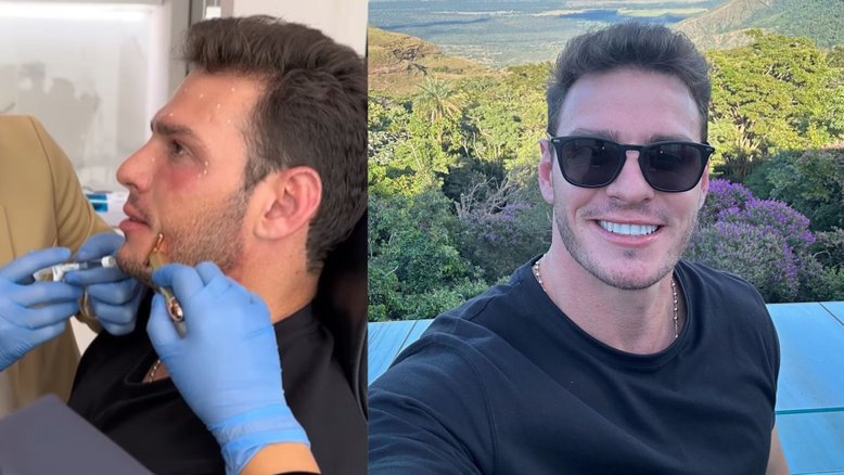 Ex-BBB Gustavo Benedeti passa por preenchimentos faciais e resultado impressiona
