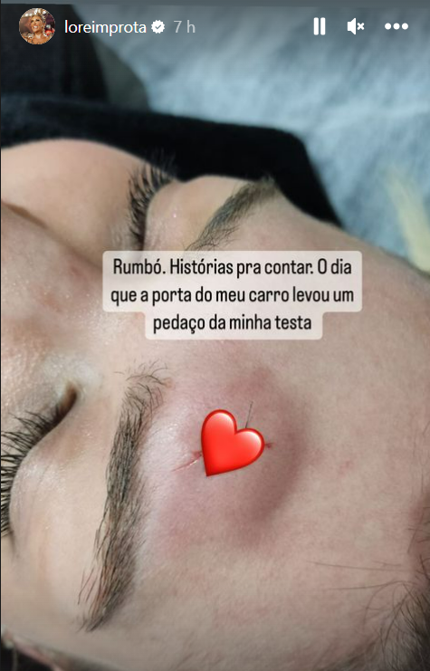 Lore Improta leva pontos no rosto após sofrer acidente doméstico 12 Lore Improta leva pontos no rosto após sofrer acidente doméstico