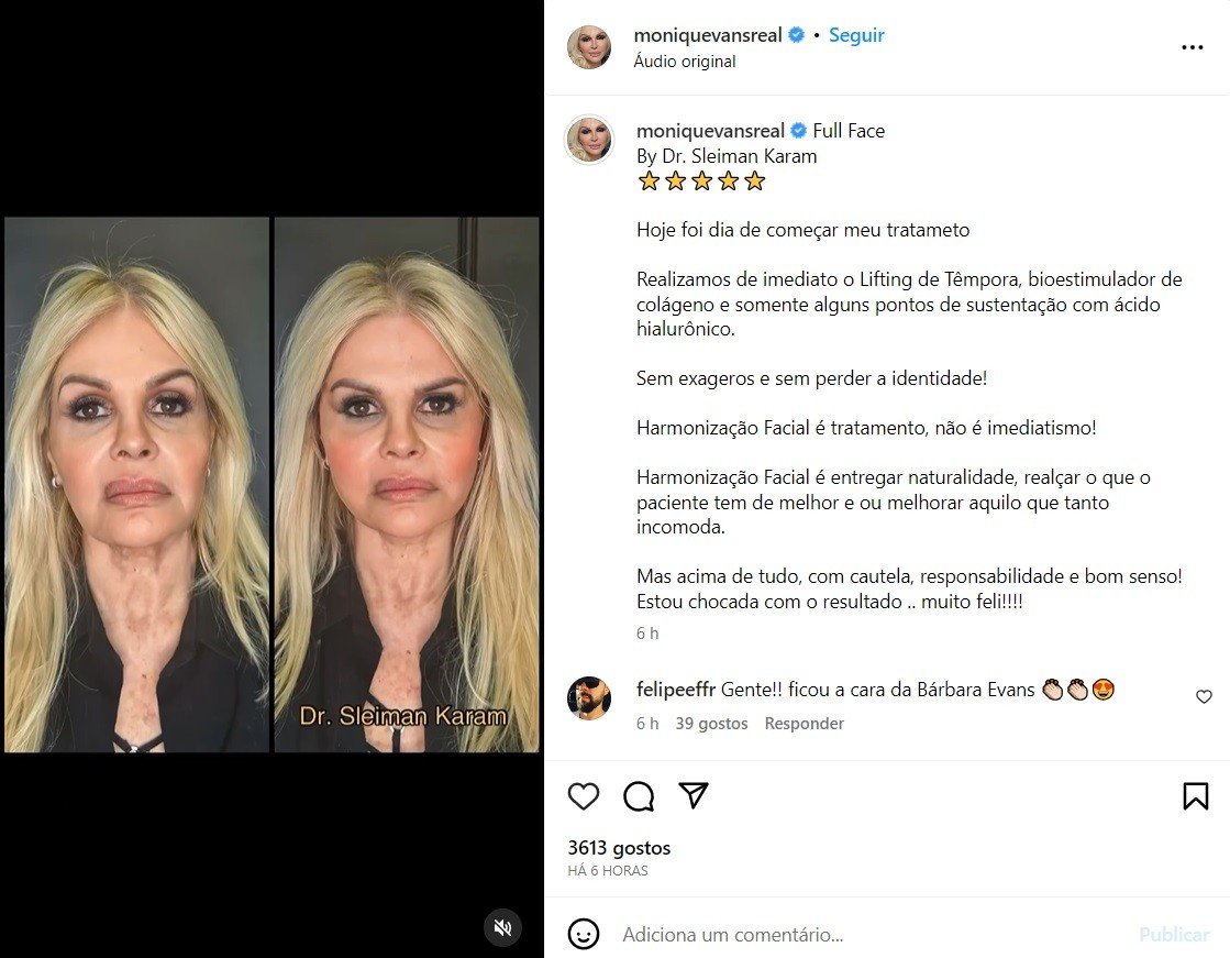 Monique Evans mostra rosto sem filtro após harmonização facial 2 Monique Evans mostra rosto sem filtro após harmonização facial