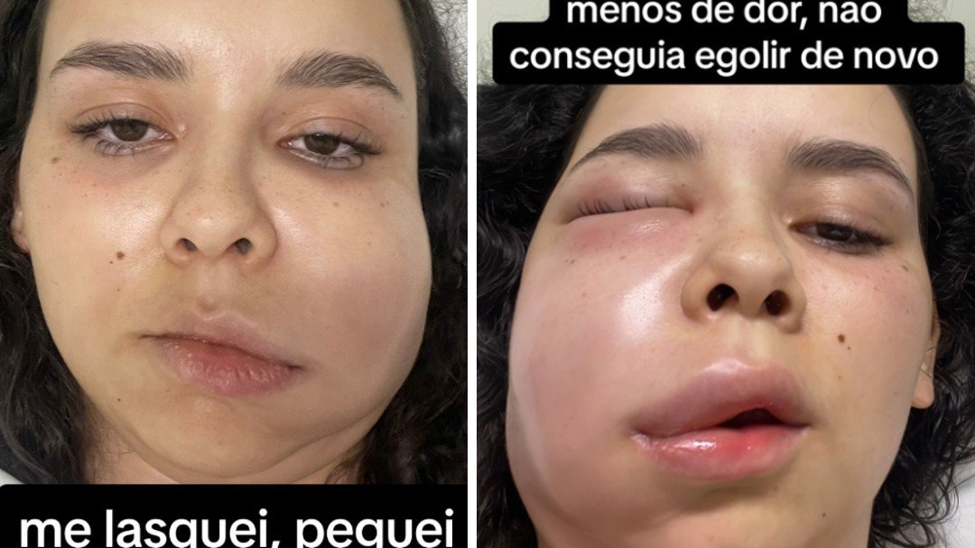 Jovem tem infecção após retirada dos sisos e viraliza nas redes ao mostrar evolução do caso
