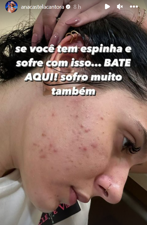 Ana Castela faz desabafo sobre acne nas redes sociais: 'Sofro muito' 4 Story de Ana Castela