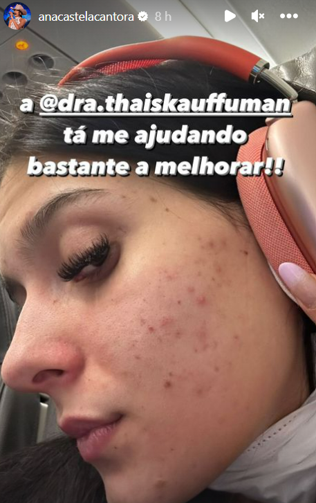 Ana Castela faz desabafo sobre acne nas redes sociais: 'Sofro muito' 5 Story de Ana Castela