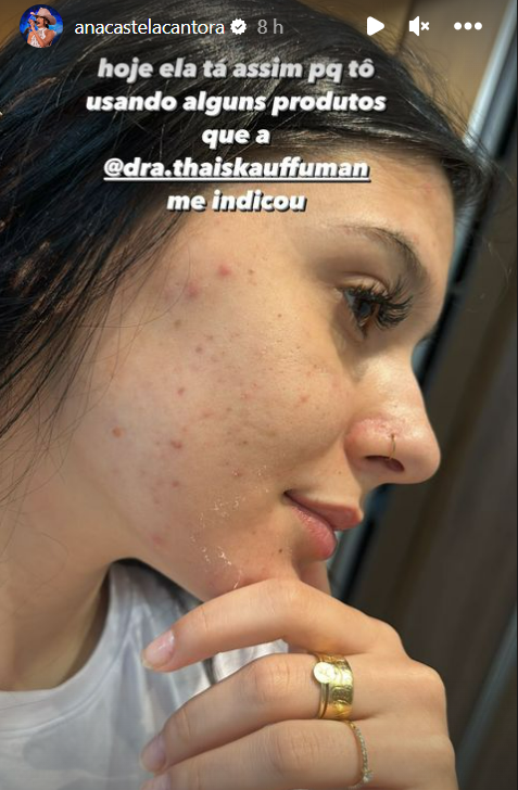 Ana Castela faz desabafo sobre acne nas redes sociais: 'Sofro muito' 6 Story de Ana Castela