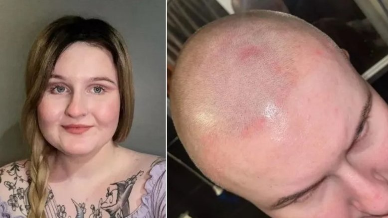 Mulher fica careca após problema com extensões de cabelo
