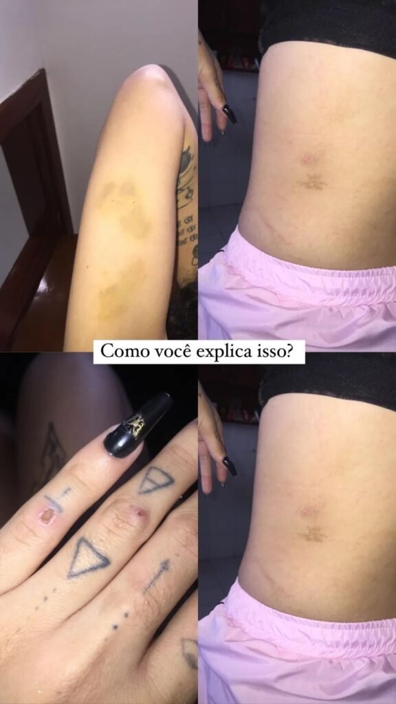 Atriz de 'Vai na Fé', Azzy acusa ex-marido de agressão e mostra hematomas