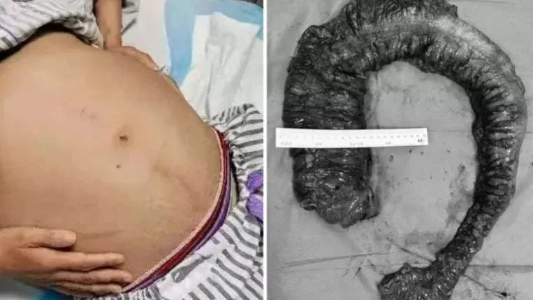 Chinesa passa por cirurgia para retirar cocô gigante de um metro e 20 kg