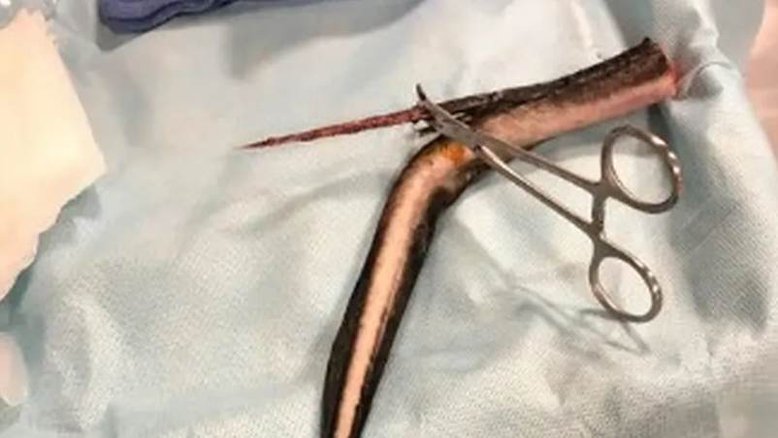 Mulher fica com ferrão de arraia cravado nas costas após entrar em praia dos EUA