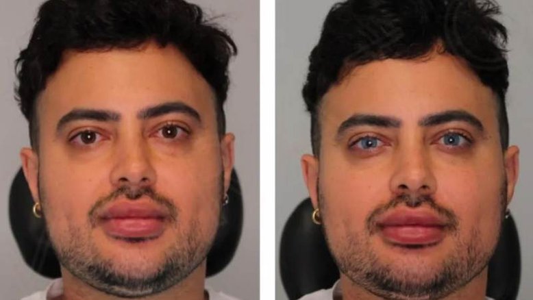 Homem faz procedimento para mudar a cor dos olhos permanentemente e viraliza nas redes