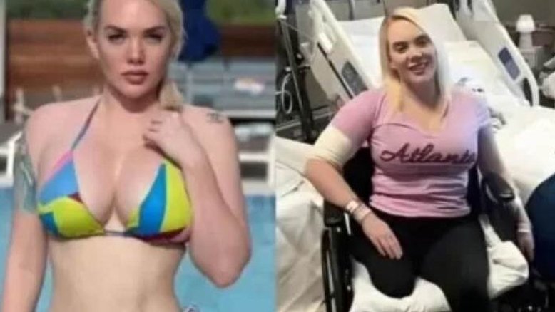 Americana tem perna amputada após infecção por bactéria carnívora